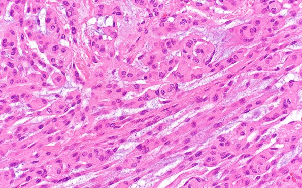 4B4 Meningioma, chordoid (Case 4) H&E 5