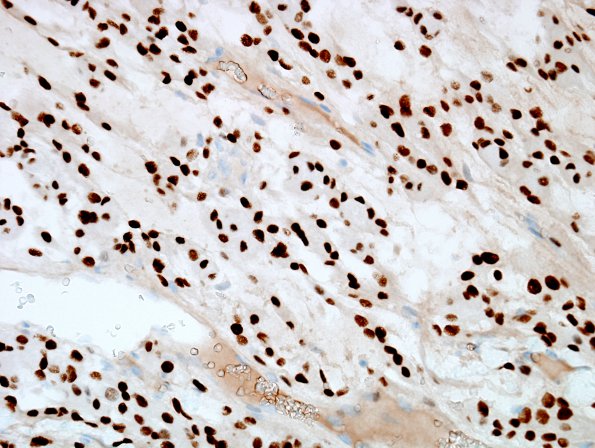 4C Meningioma, chordoid (Case 4) PR 1.jpg