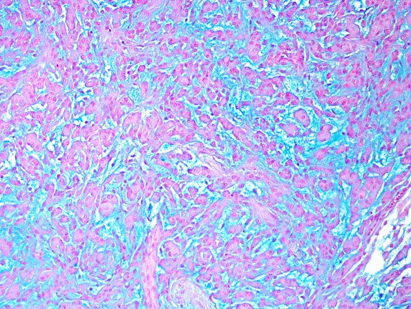 4D1 Meningioma, chordoid (Case 4) Alcian Blue 2.jpg