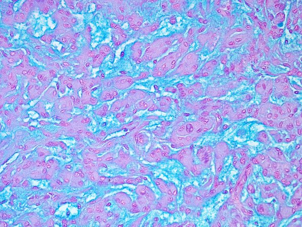 4D2 Meningioma, chordoid (Case 4) Alcian Blue 3.jpg