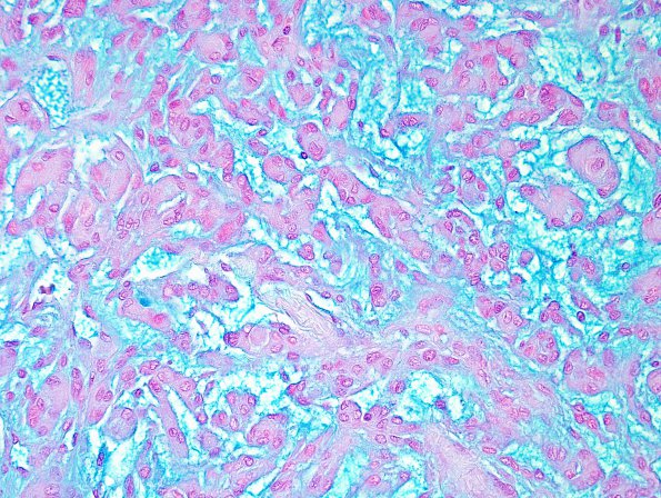 4D3 Meningioma, chordoid (Case 4) Alcian Blue 1.jpg