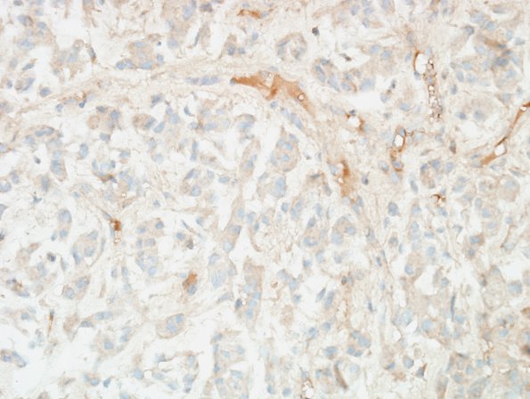 4E Meningioma, chordoid (Case 4) Brachyury 1.jpg