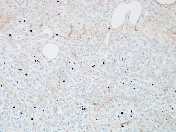 4F Meningioma, chordoid (Case 4) Ki67 2.jpg