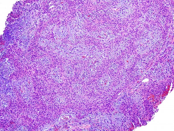 5A1 Meningioma, Chordoid (Case 5)