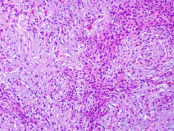 5A2 Meningioma, Chordoid (Case 5) H&E 1