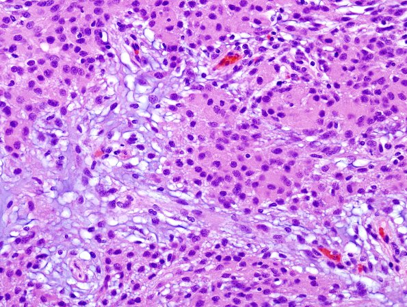 5A3 Meningioma, Chordoid (Case 5) H&E 5