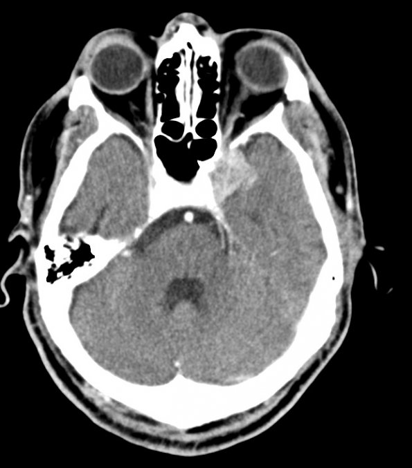 6A Meningioma, atypical WHO 2 (Case 6) CT 1 - Copy