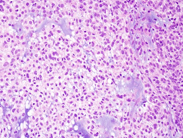 6B1 Meningioma, focal chordoid (Case 6)H&E 4.jpg