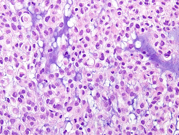 6B2 Meningioma, chordoid (Case 6) H&E 8.jpg