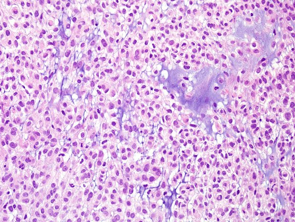 6B3 Meningioma, atypical WHO 2 (Case 6) focal chordoid H&E 2a.jpg