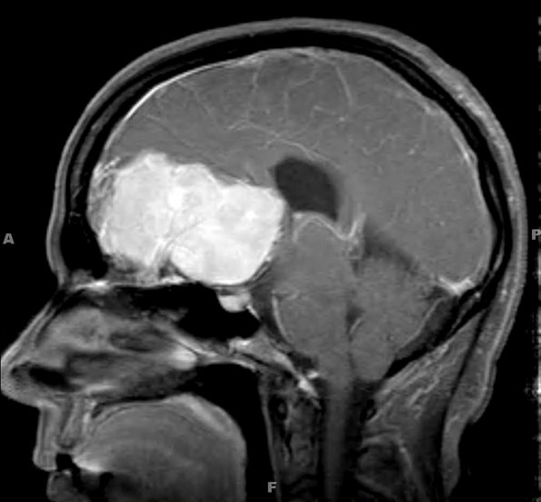 7A1 Meningioma, chordoid (Case 7) MRI 1A - Copy