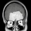 7A2 Meningioma, chordoid (Case 7) MRI 3A - Copy