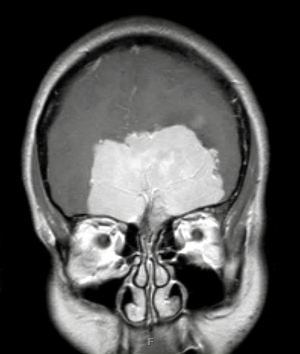 7A2 Meningioma, chordoid (Case 7) MRI 3A - Copy