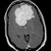 7A3 Meningioma, chordoid (Case 7) MRI 4A - Copy