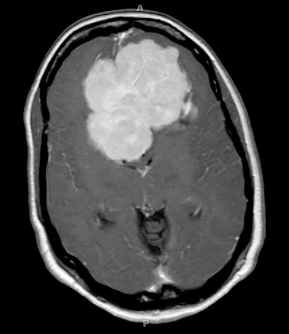 7A3 Meningioma, chordoid (Case 7) MRI 4A - Copy