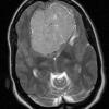 7A4 Meningioma, Chordoid (Case 7) T2 W 1 - Copy