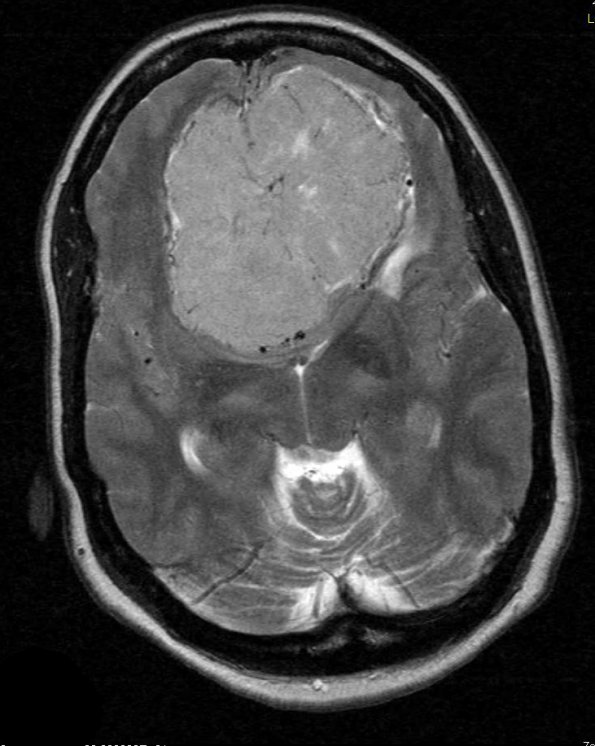 7A4 Meningioma, Chordoid (Case 7) T2 W 1 - Copy