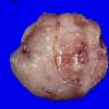 7B1 Meningioma, chordoid (Case 7) 1