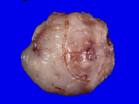 7B1 Meningioma, chordoid (Case 7) 1