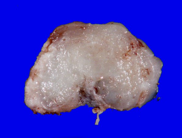 7B2 Meningioma, chordoid (Case 7) 3