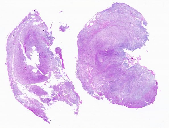 7C1 Meningioma, Chordoid (Case 7) H&E WM