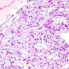 7C2 Meningioma, Chordoid (Case 7) H&E 1