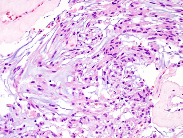 7C2 Meningioma, Chordoid (Case 7) H&E 1