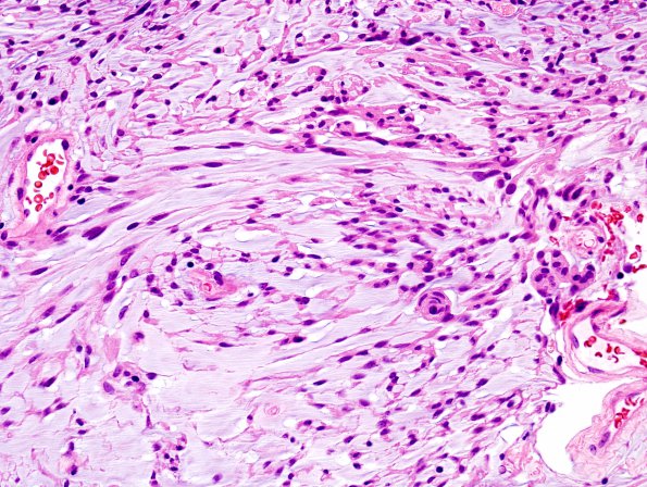 7C3 Meningioma, Chordoid (Case 7) H&E 3