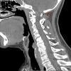 8A Meningioma, Chordoid (Case 8) CT 1 copy