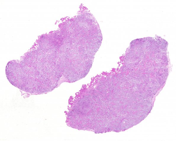 8B1 Meningioma, Chordoid (Case 8) H&E WM