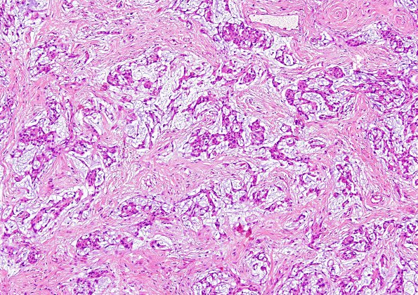 8B2 Meningioma, Chordoid (Case 8) H&E 8