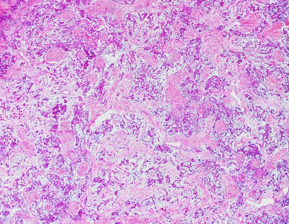 8B3 Meningioma, Chordoid (Case 8) H&E 9