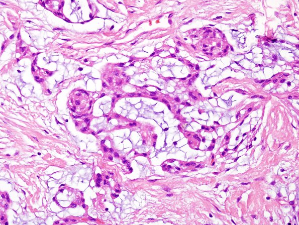 8B4 Meningioma, Chordoid (Case 8) H&E 7