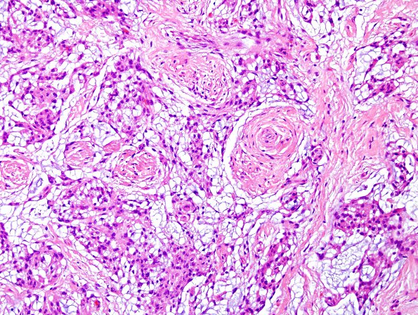 8B5 Meningioma, Chordoid (Case 8) H&E 6