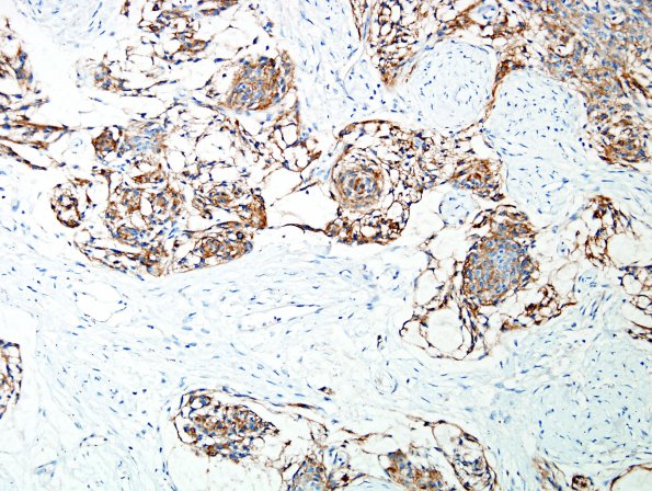 8C2 Meningioma, Chordoid (Case 8) EMA 3