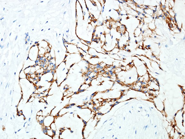 8C3 Meningioma, Chordoid (Case 8) EMA 1