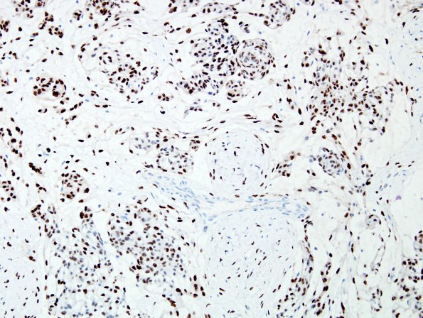 8D Meningioma, Chordoid (Case 8) PR 4