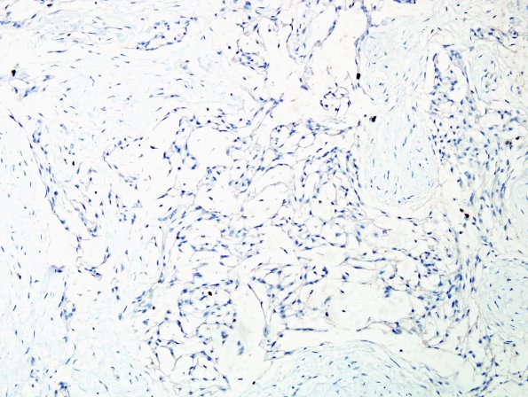 8E Meningioma, Chordoid (Case 8) MIB 1