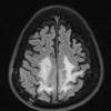 9A1 Meningioma, chordoid (Case 9) TIRM 1 - Copy