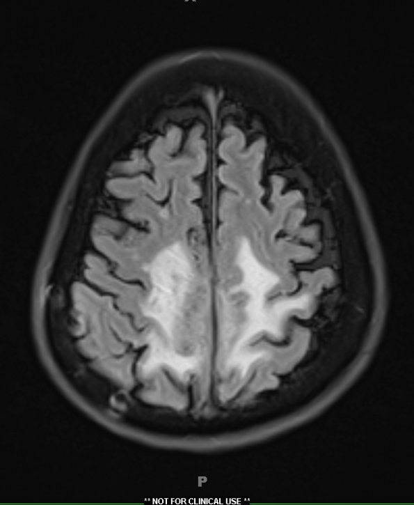 9A1 Meningioma, chordoid (Case 9) TIRM 1 - Copy