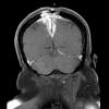 9A2 Meningioma, chordoid (Case 9) T1W 3 - Copy