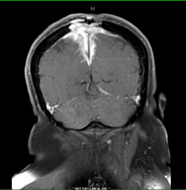 9A2 Meningioma, chordoid (Case 9) T1W 3 - Copy