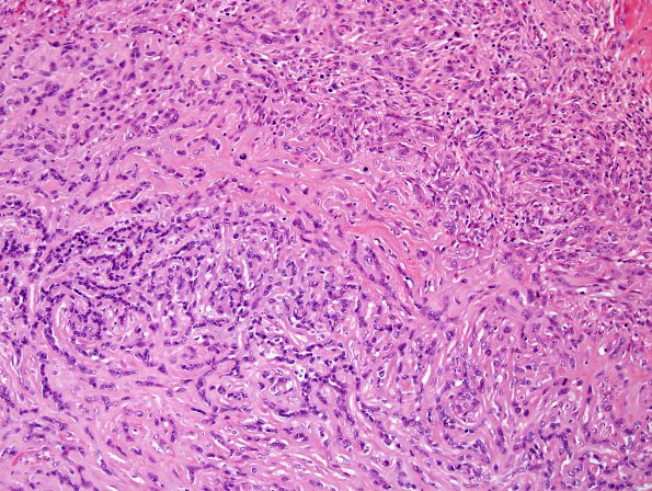 9B1 Meningioma, chordoid (Case 9) H&E 5.jpg