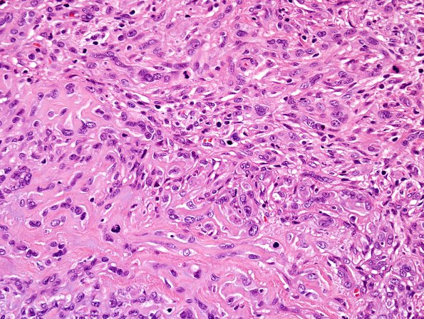 9B2 Meningioma, chordoid (Case 9) H&E 3.jpg