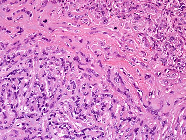 9B3 Meningioma, chordoid (Case 9) H&E 4.jpg