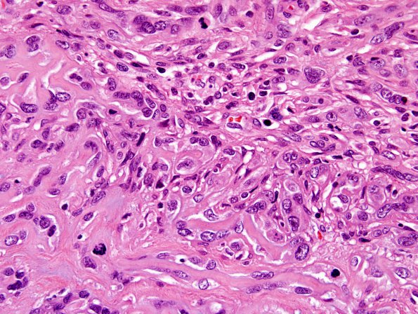 9B4 Meningioma, chordoid (Case 9) H&E 2.jpg