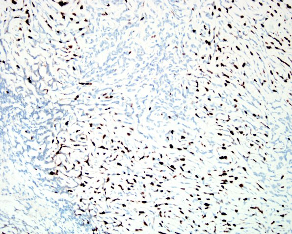 9C Meningioma, chordoid (Case 9) Ki67 1.jpg