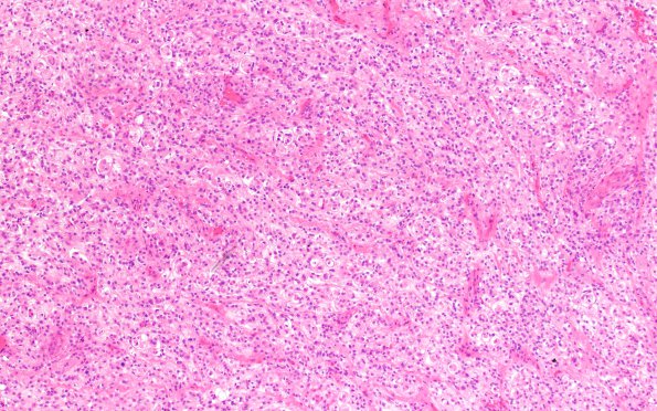 12C1 Clear cell meningioma (Case 12)  H&E 10X