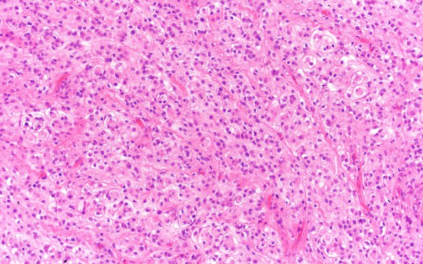 12C2 Clear cell meningioma (Case 12)  H&E 20X