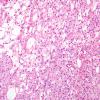 13A1 Meningioma, atypical, microcystic-clear cell (Case 13) H&E 1